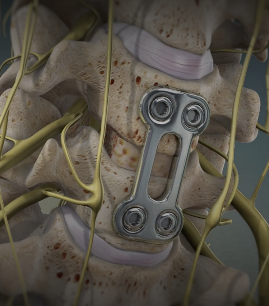 cervical arthrodesis disc fusion