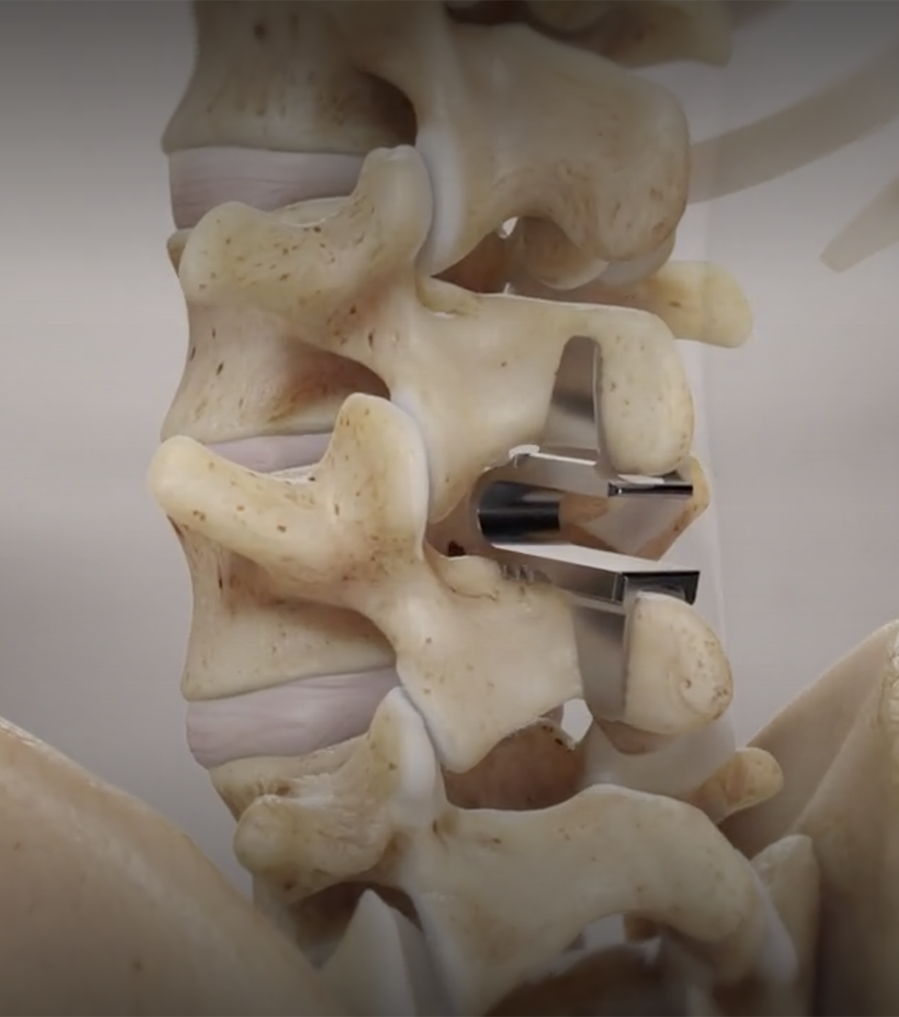 Coflex Interlaminar Stabilization