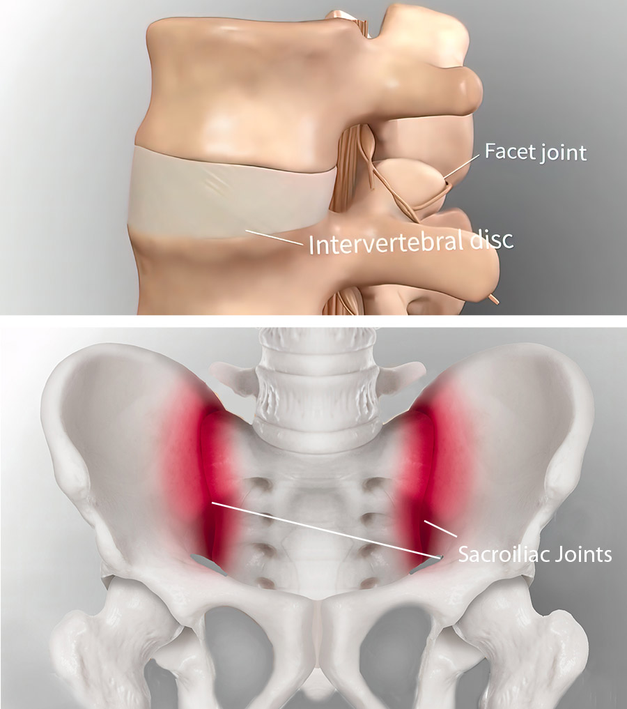 sacroiliac and facet joint treatment