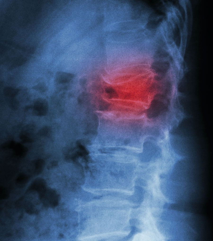 fractured spine for kyphoplasty