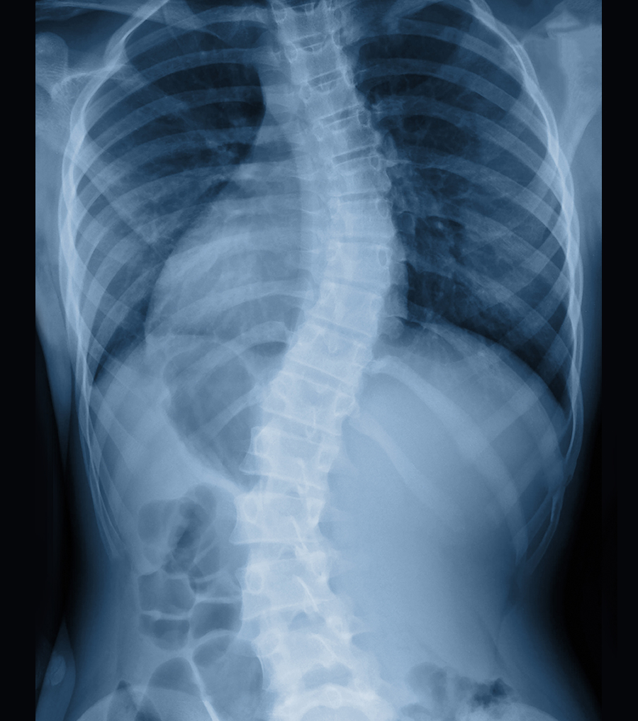 spine deformity reconstruction